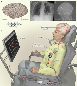 Hjerneimplantat gør schleroseramt patient i stand til at kontrollere computer